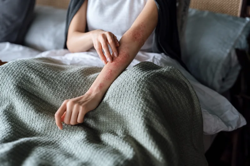 Persoon met zichtbare eczeemplekken op de arm, passend bij eczeem en psoriasis